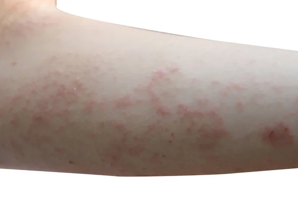 Depositphotos 174481852 Stock Photo Red Rash On The Arms
