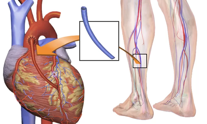 Blausen 0466 Heart Bypass Surgery 700x419 1