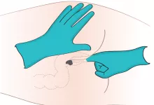 Administering Med Rectally 2