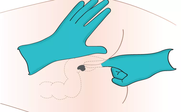 Administering Med Rectally 2