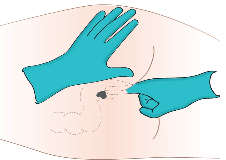 Administering Med Rectally 2