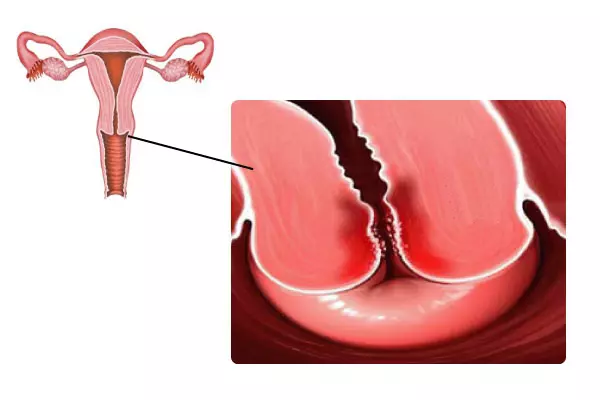 Cervicitis