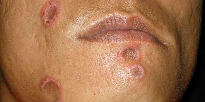 Kak Peredaetsja Projavljaetsja I Lechitsja Sifilis 99a00f4