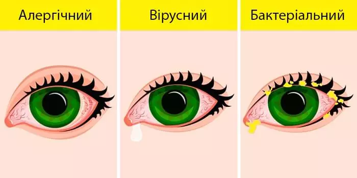 Vydy Konyuktyvitu