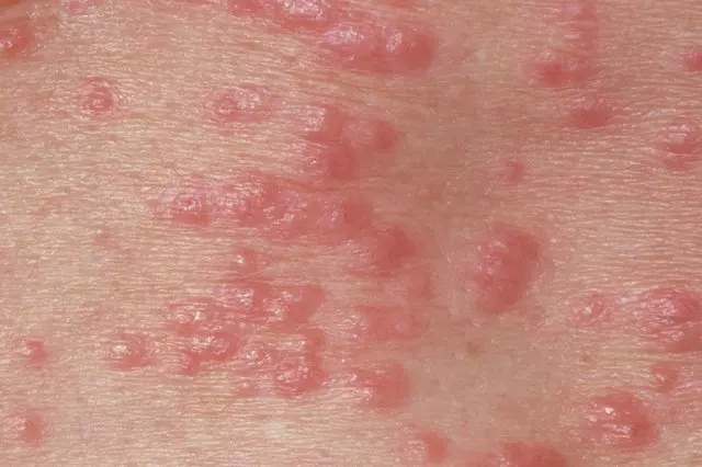 M2600127 Red Papules On The Skin Due To Scabie.width 640 0